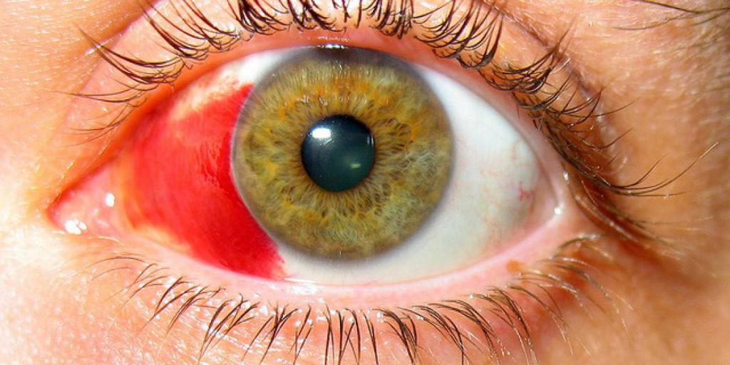 гипосфагма глаз залит кровью причины