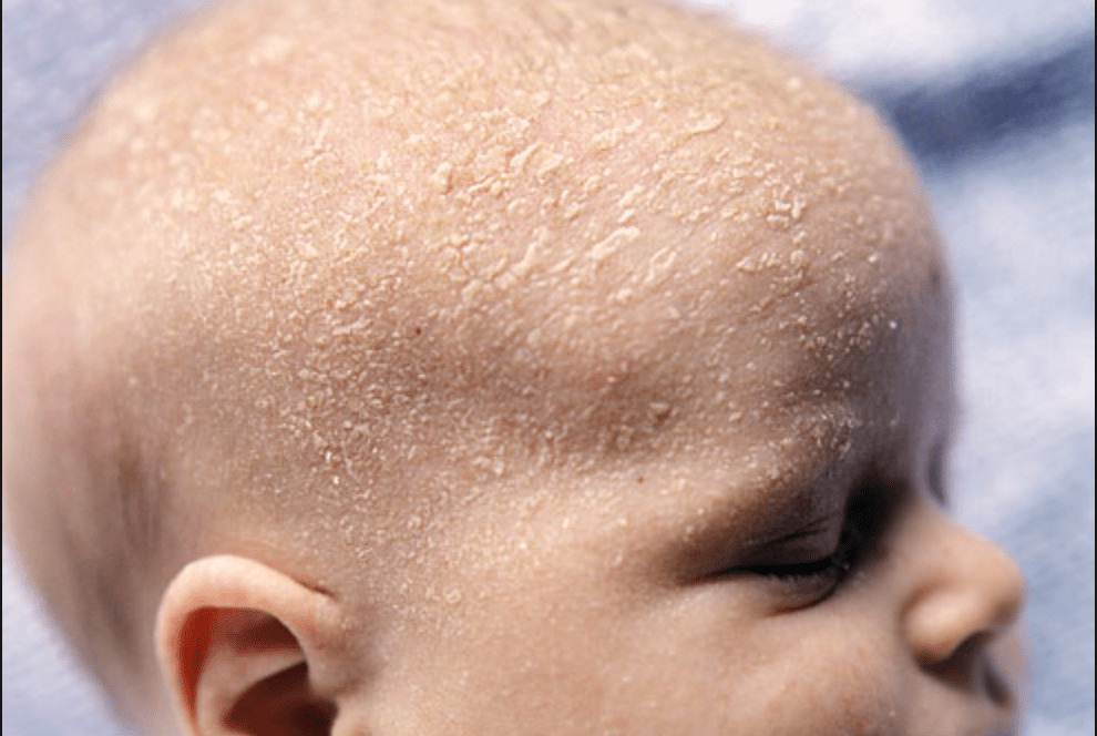 аллергический дерматит на голове у ребенка