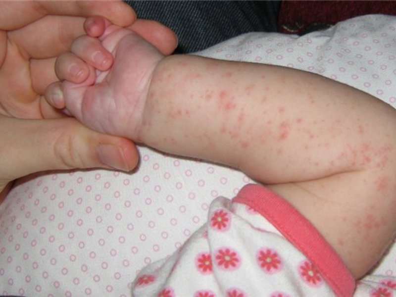 аллергический дерматит на ноге у ребенка