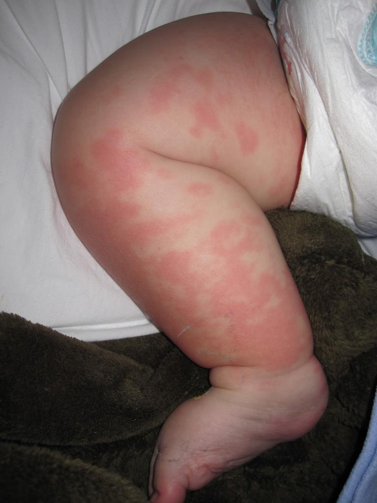 аллергический дерматит фото