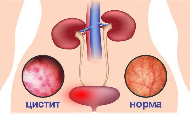 экстренная помощь при цистите