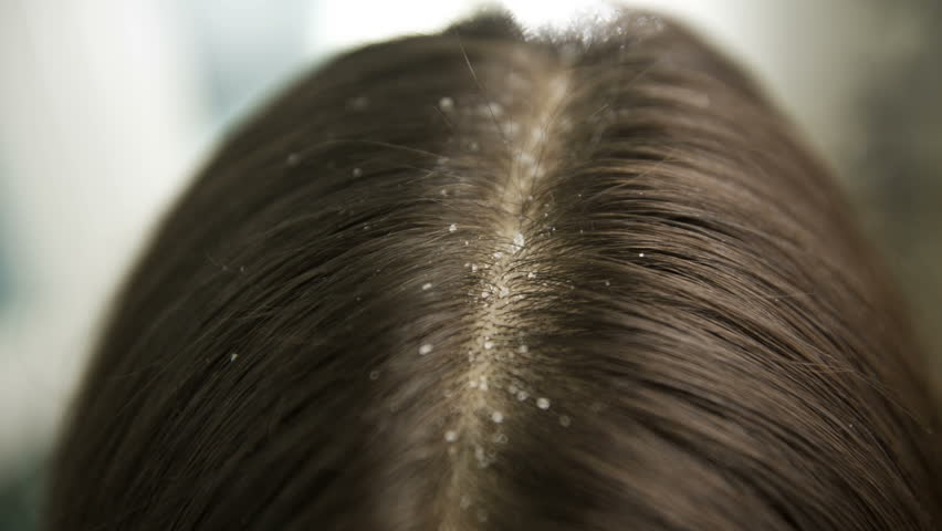 средства от себореи волосистой части головы