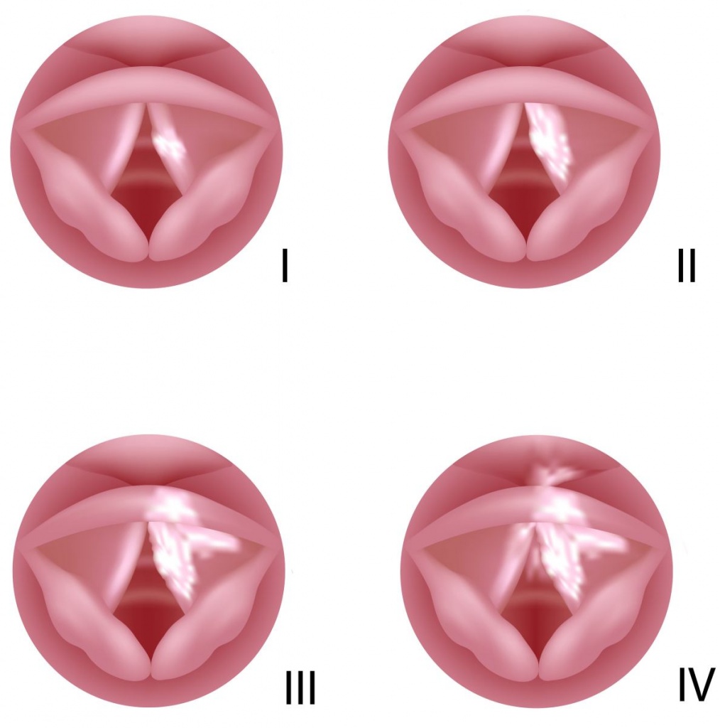 Женские малые половые губы. Злокачественные опухоли гортани. Новообразование на голосовых связках. Злокачественные опухоли гортаноглотки.