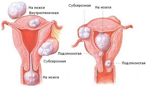 Симптомы фибромы матки