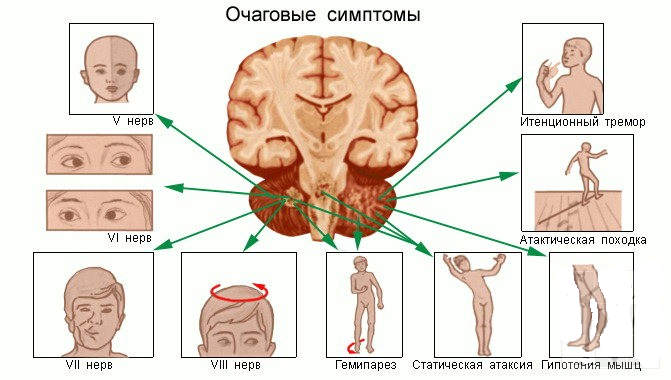 Как проявляется рак головного мозга