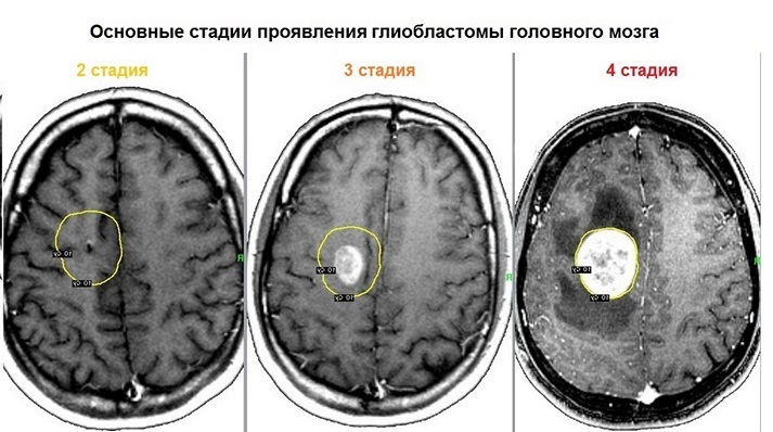 Причины рака мозга