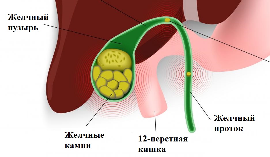 Для эхографической картины острого холецистита характерно тест