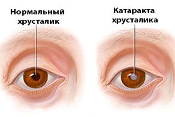 отличие глаукомы от катаракты