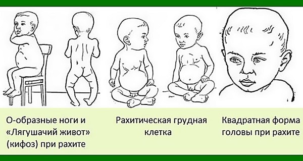 отличительные признаки рахита у грудничка