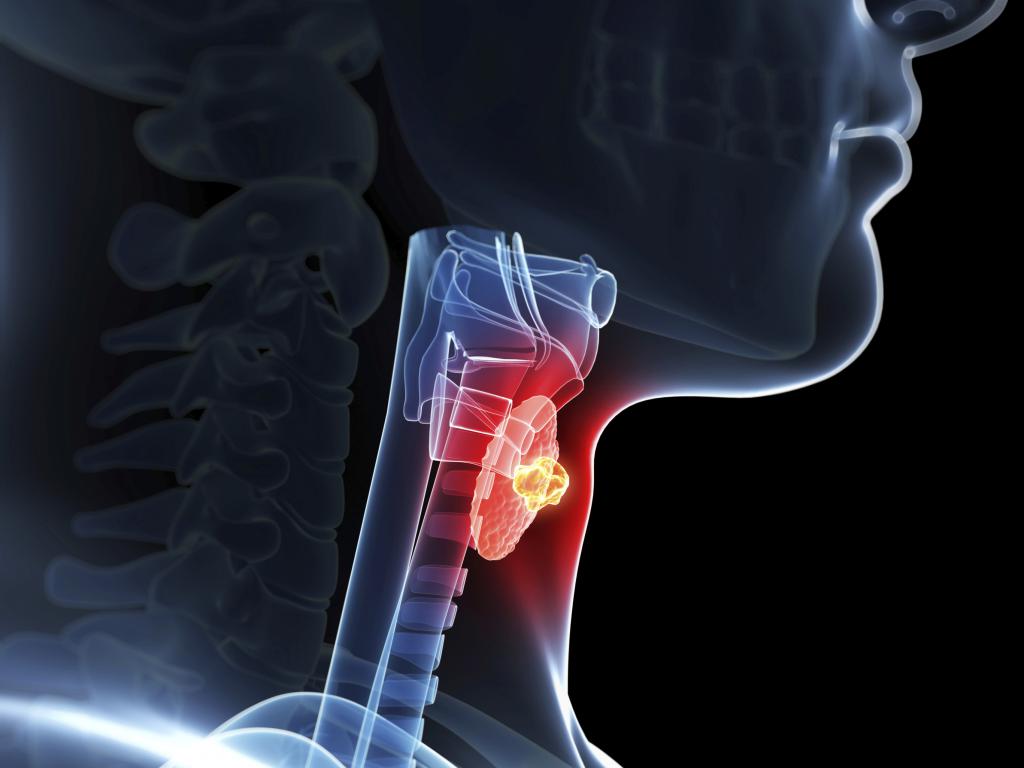 щитовидная железа гипоплазия левой доли