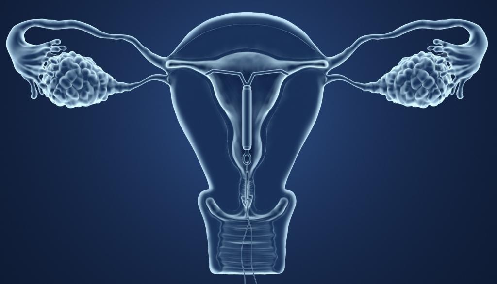 where you can remove the intrauterine device doctor woman