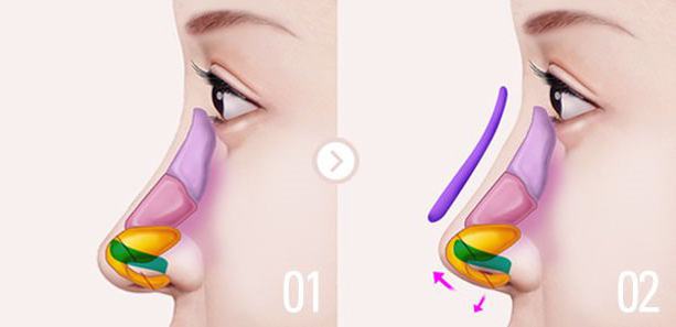 хирургическая коррекция деформации кончика носа 