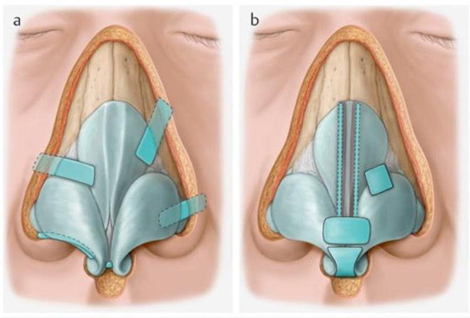 nose tip correction reviews