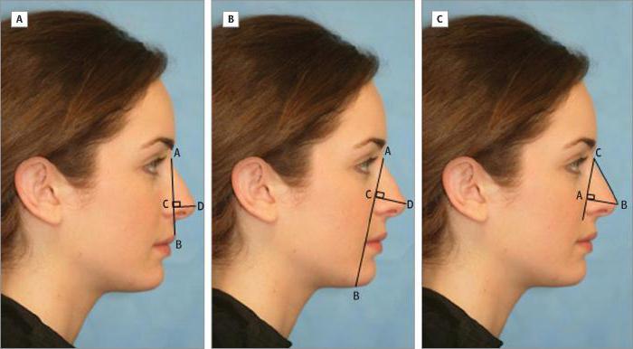 коррекция кончика носа без операции 