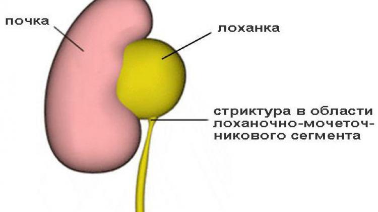 стриктура мочеточника причины