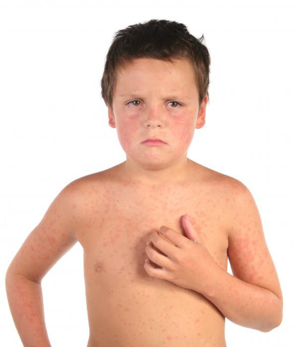 Аллергия на скумбрию у ребенка thumbnail