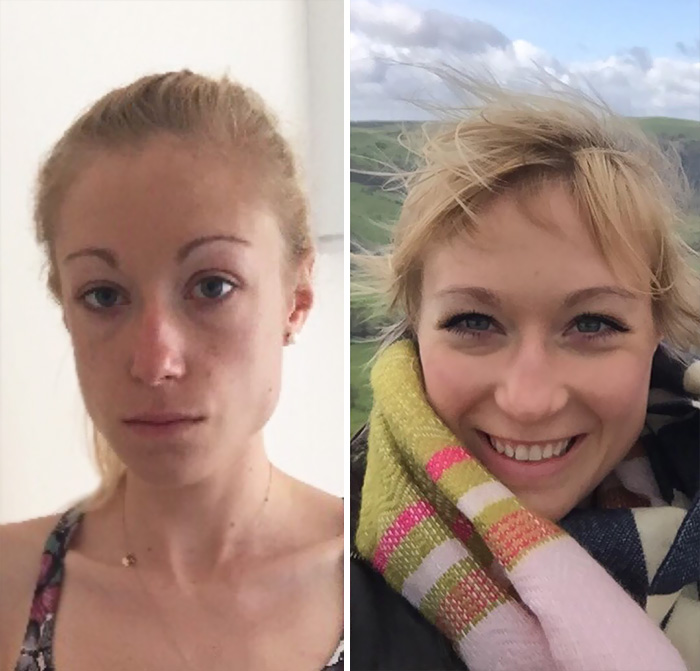 фото до и после анорексии