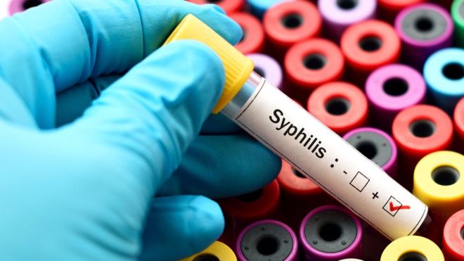 диагностика сифилиса