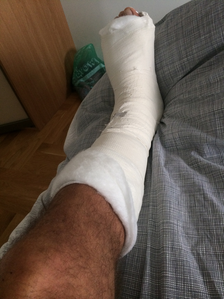 нога после операции
