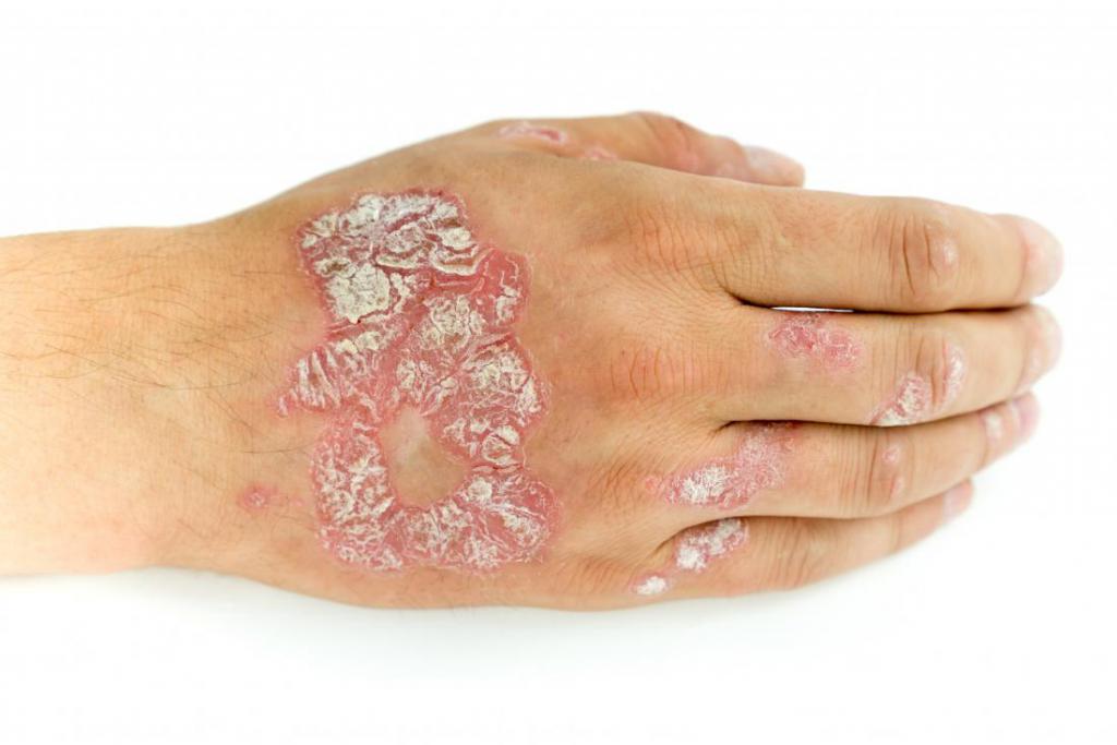 Damage to the skin of the hands with psoriasis