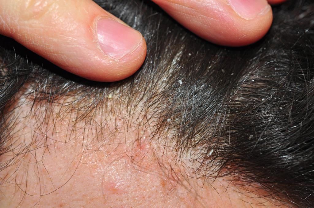 Psoriasis on the head