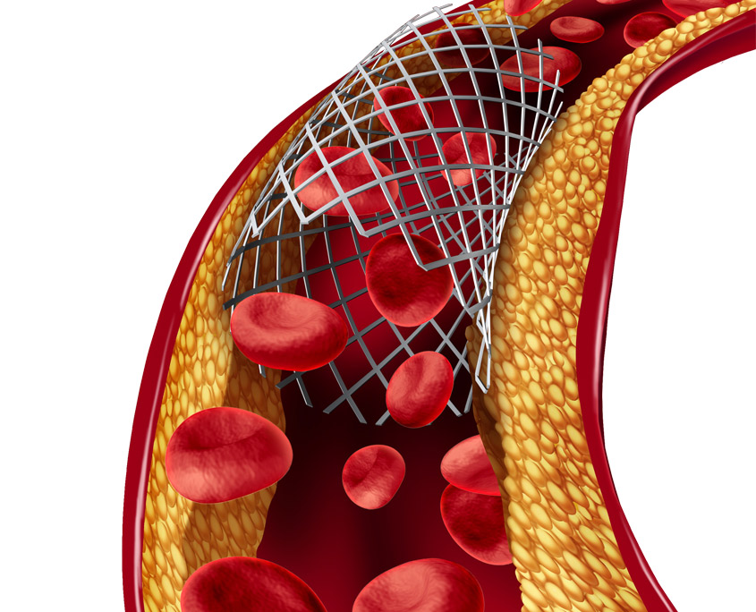 Вид артерии изнутри