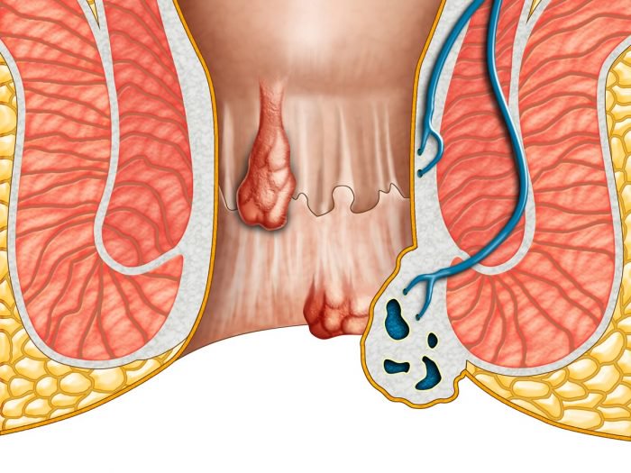 what does hemorrhoids look like