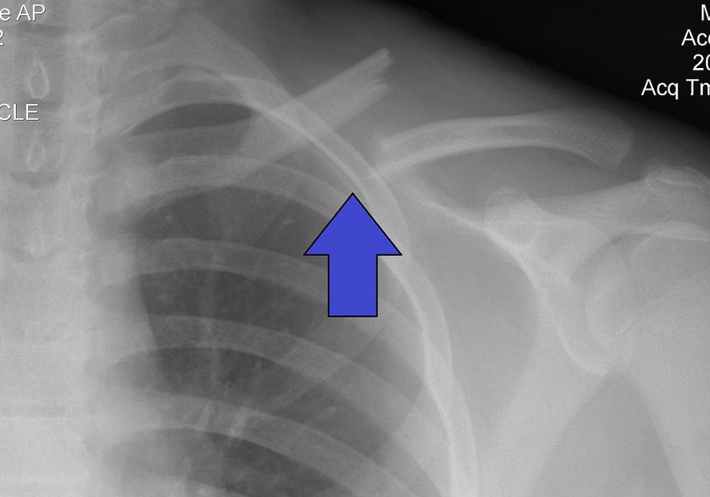 Рентгенограмма перелома ключицы
