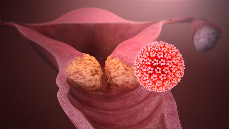 Фото симптомов вируса папилломы человека у женщин