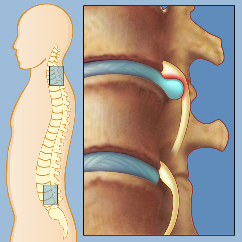 median hernia