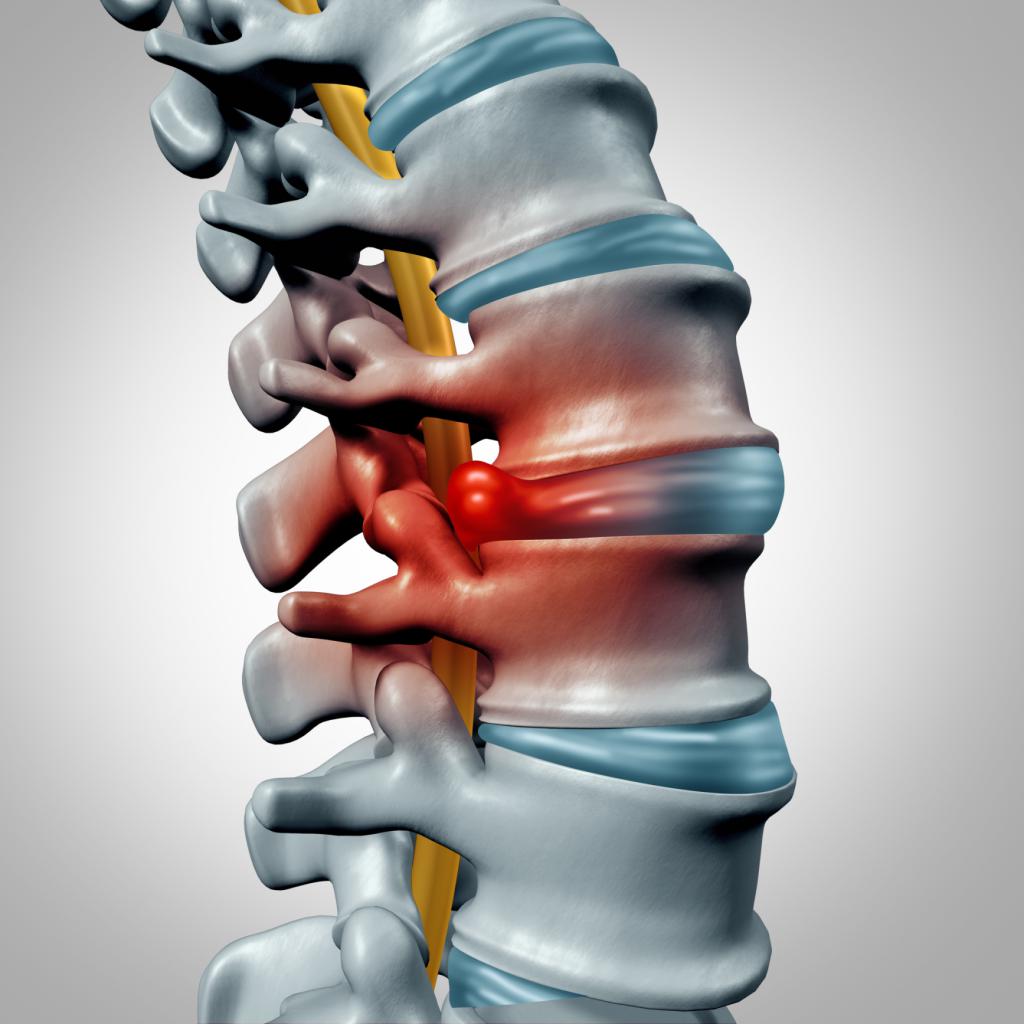 median paramedian disc herniation