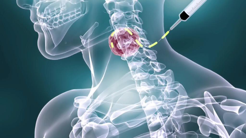 hodgkin's lymphoma