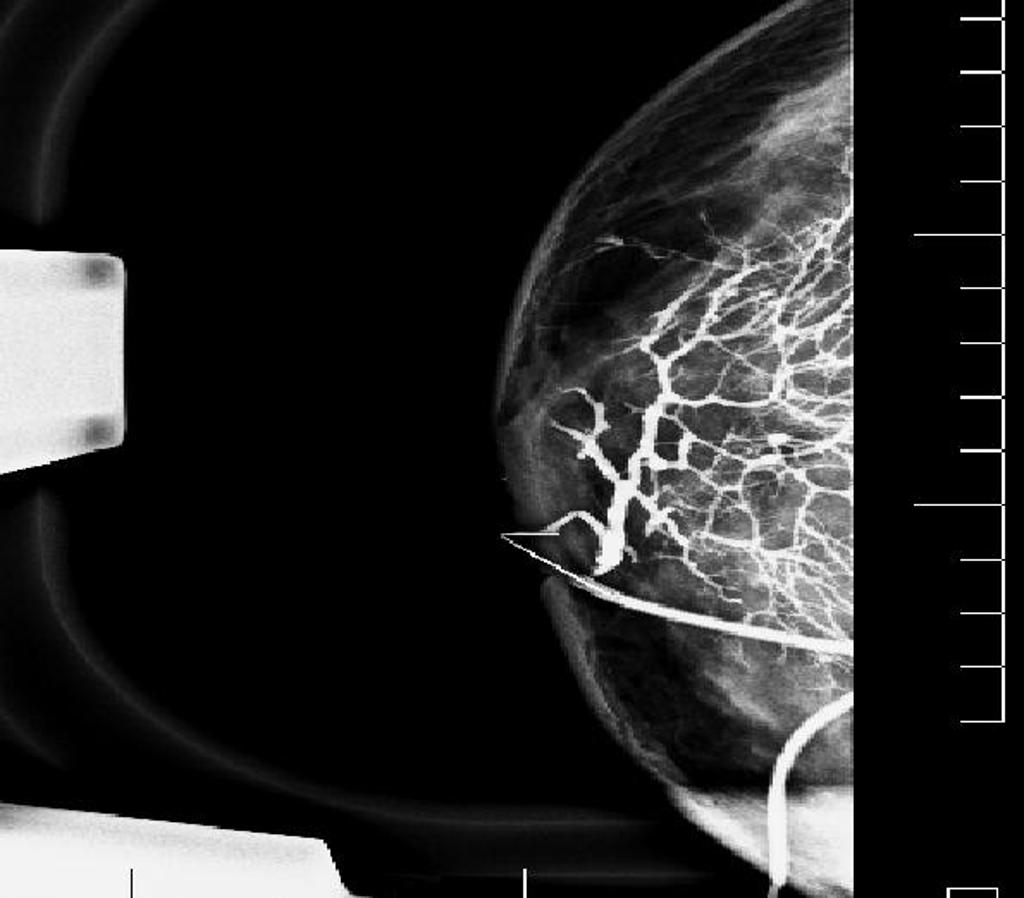 Железа в железе маммография. Дуктография молочной железы. Маммография дуктография. Дуктография молочной железы дефект наполнения. Дуктография мастопатия.