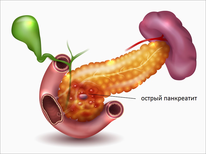 acute pancreatitis Atlanta classification