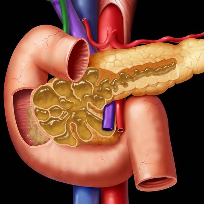 complications of acute pancreatitis classification