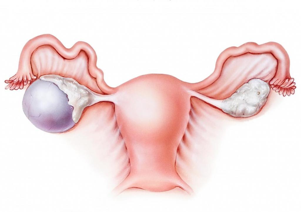 why ovarian cysts form