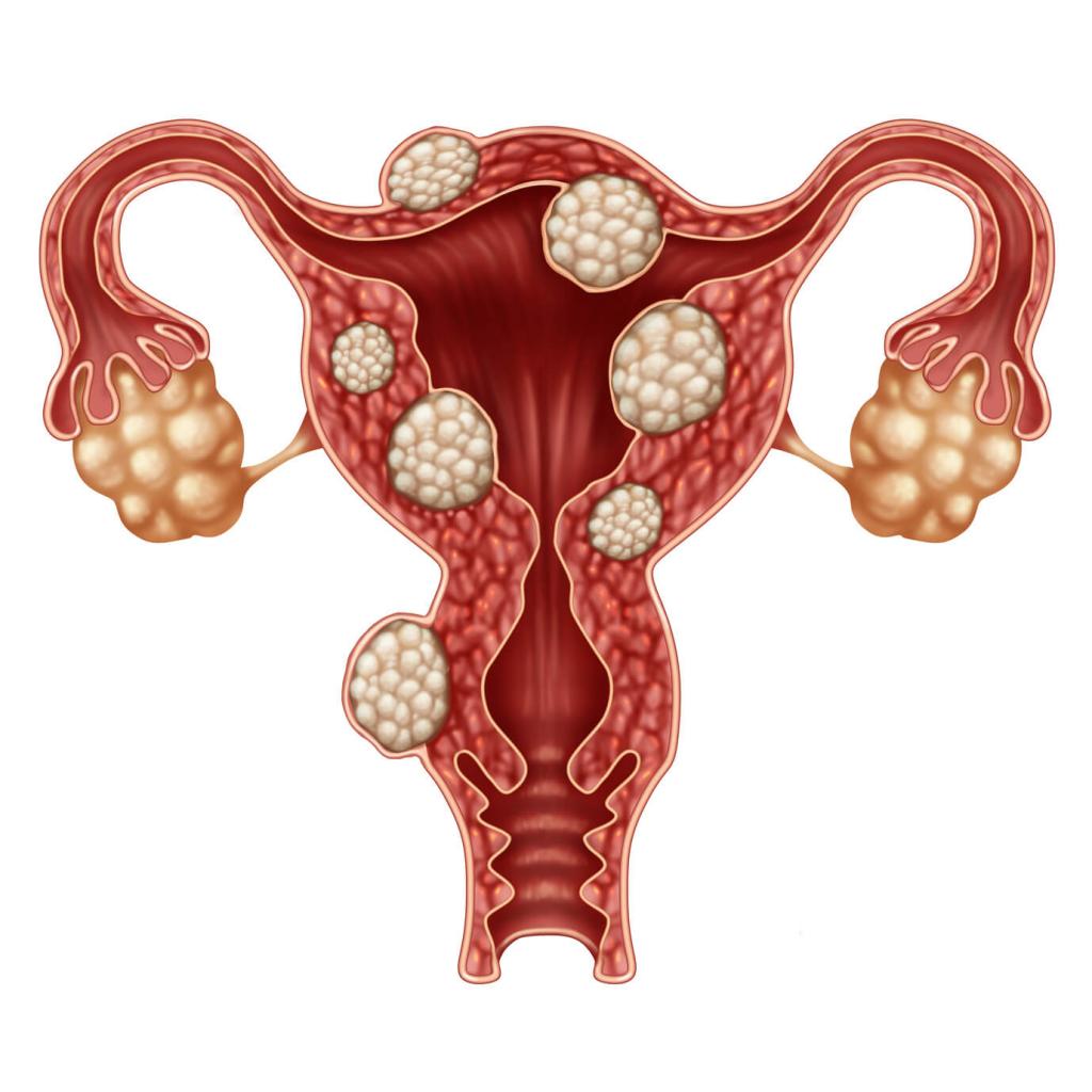 laparoscopy of ovarian cysts reviews