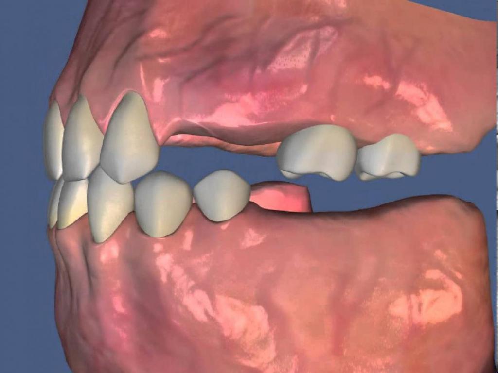 Partial Secondary Adentia