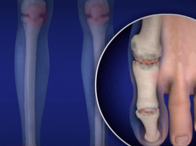 Foot Joint Disease Treatment