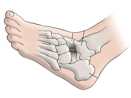 Arthritis Foot Treatment