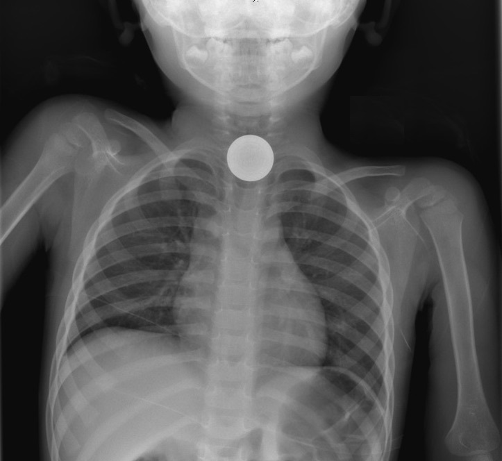 Инородные тела дыхательных путей причины. Обструкция дыхательных путей рентген. Инородное тело в дыхательных путях рентген. Инородное тело в дыхательных путях у ребенка рентген. Инородные тела у детей рентген.