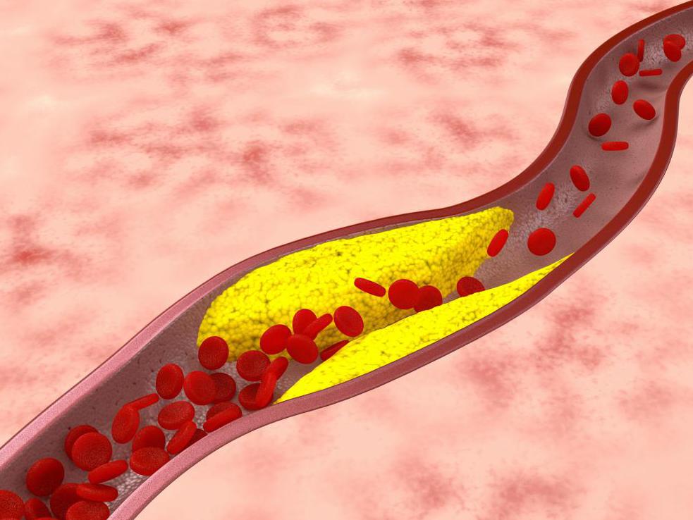 атеросклероз аорты коронарных артерий