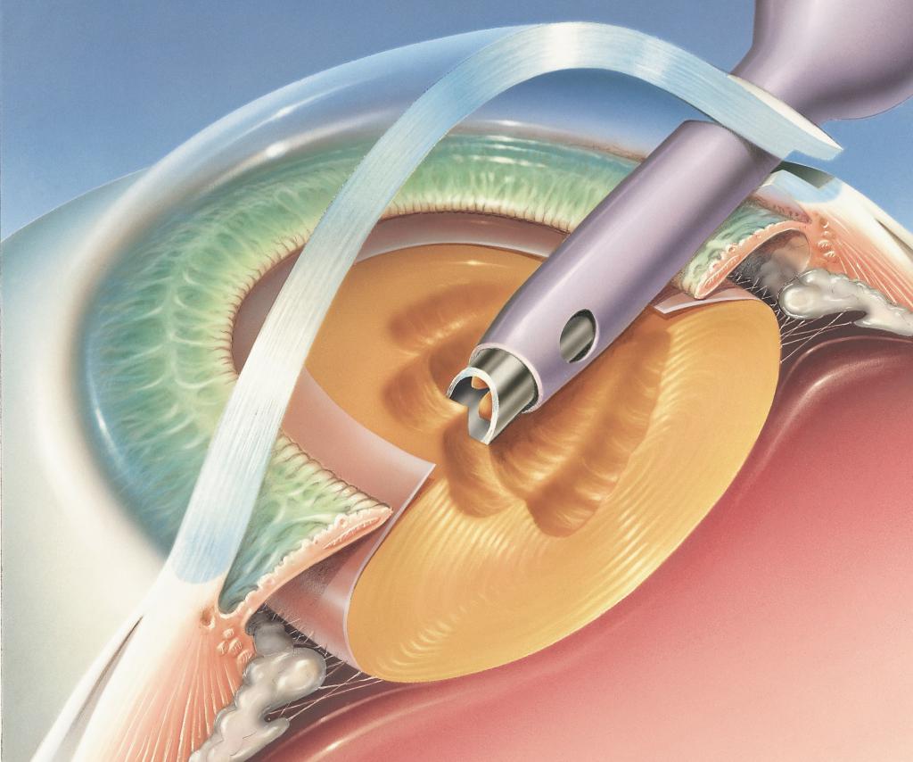 Этапы проведения операции по удалению катаракты