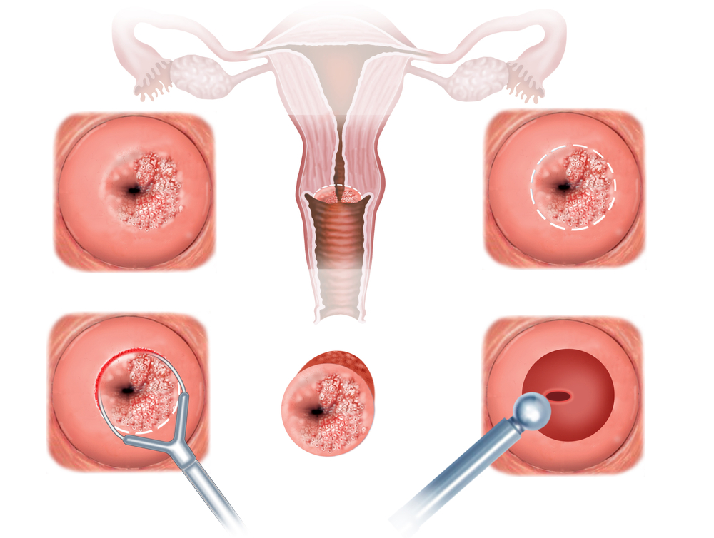 What is uterine dysplasia