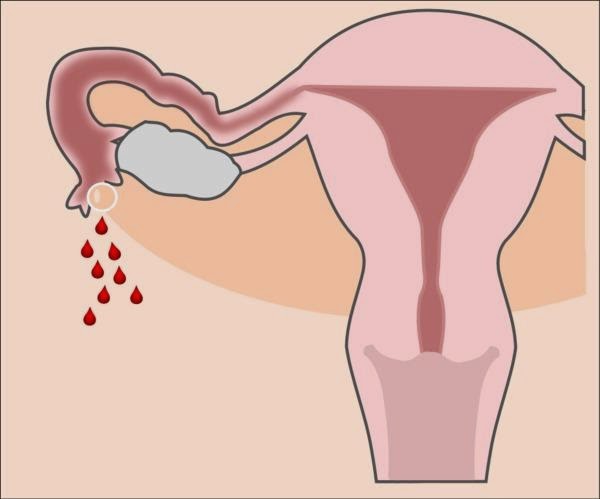 The nature of the discharge after an abortion