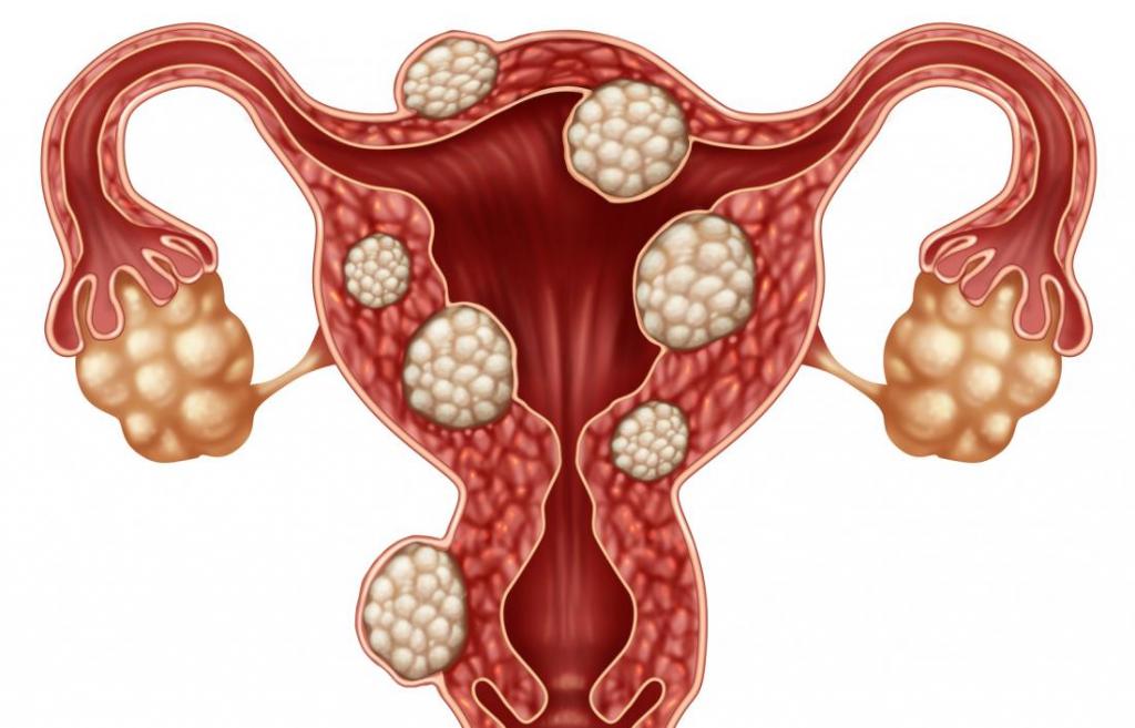 uterine fibroids what kind of disease is this photo