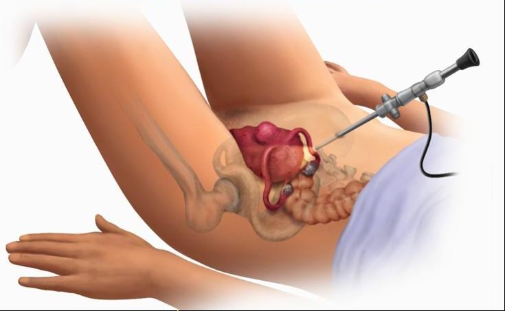 Operation with uterine myoma