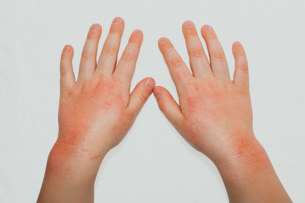 Контактный дерматит фото на руках у детей