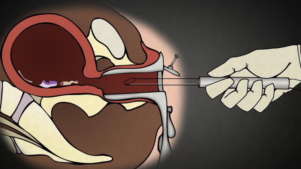 Как проходит хирургический аборт