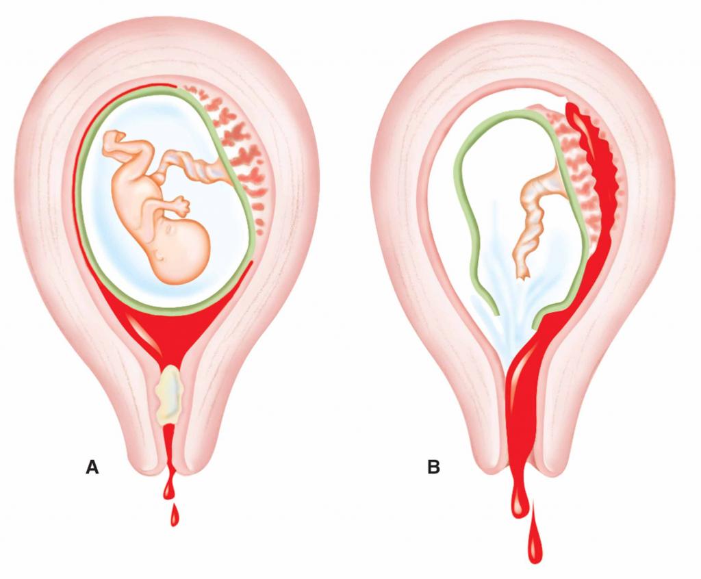 Complications of Vacuum Abortion
